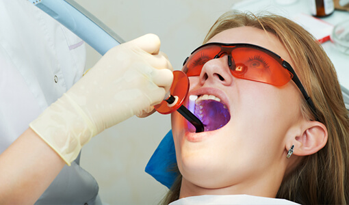 Composite Fillings